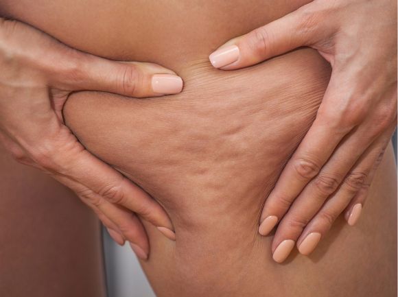 CELLULITE e RITENZIONE IDRICA - Le differenze, cause e rimedi