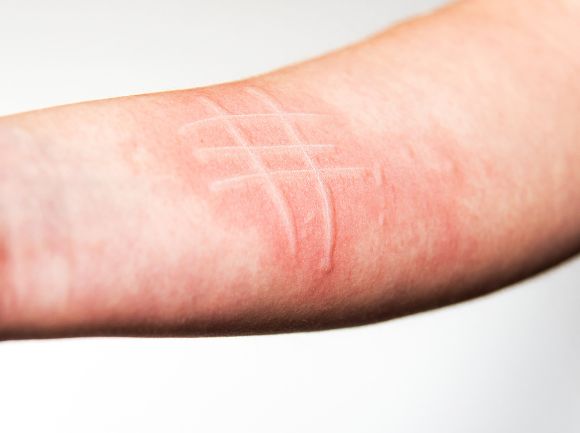 DERMOGRAFISMO - Cos'è, cause e rimedi