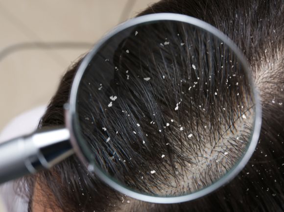 FORFORA - Come si forma, tipologie e rimedi