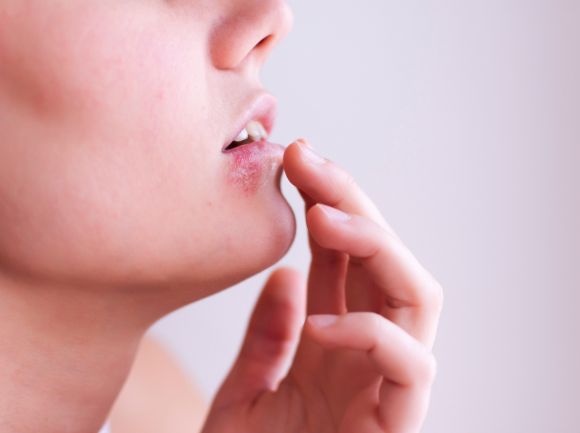 HERPES LABIALE - Cos'è e come curarlo
