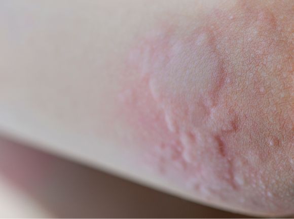 ORTICARIA