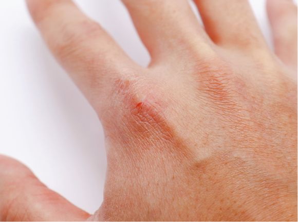 RAGADI come si formano e come prevenirle 